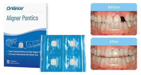 OrVance Launches The First Aligner Pontics Solution For End Patient Use