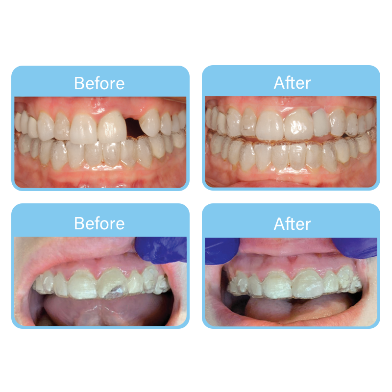 OrVance® Aligner Pontics