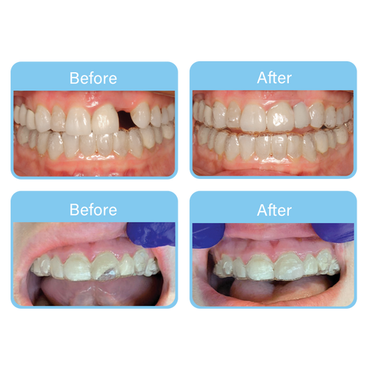 OrVance® Aligner Pontics